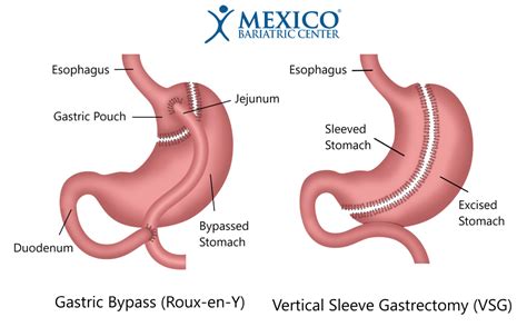 Gastric Sleeve vs. Gastric Bypass - Choosing the Right Surgery