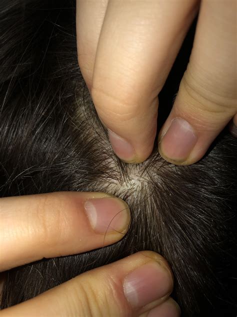 Raised bump on scalp, been there for a few years, painless but mobile. Any ideas on what it ...