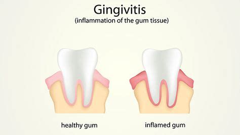 14 Home Remedies To Treat Swollen Gums + Causes And Prevention | Swollen gum, Home remedies, Gum ...