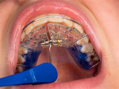 Who Needs an Expander?: Ryan Pendleton, DDS: Orthodontics