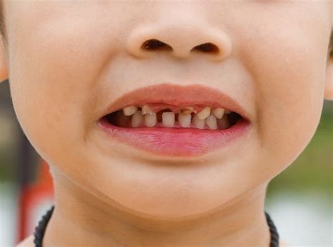 Kids Rotten Teeth Prevention - DiseaseFix