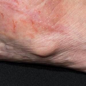 Baker's Cyst On The Leg Photograph by Dr P. Marazzi/science Photo Library