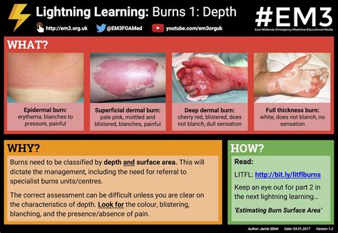 Burn Wound Depth Infographic Nursingstudents Nurseedu - vrogue.co