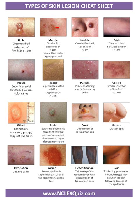 Types of Skin Lesion Cheat Sheet - NCLEX Quiz