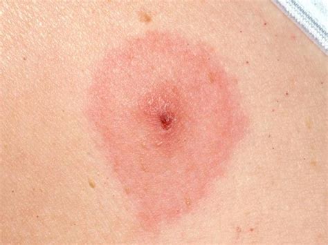 What Does A Tick Bite Rash Look Like | Images and Photos finder