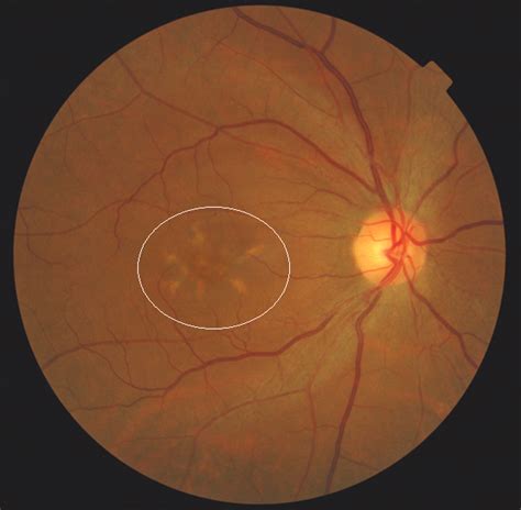 Macular Dystrophy Retina