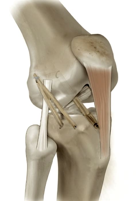 Anterior cruciate ligament reconstruction combined with anterolateral ...