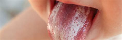 Oral Thrush Symptoms, Causes and Treatments Explained | Nature's Best