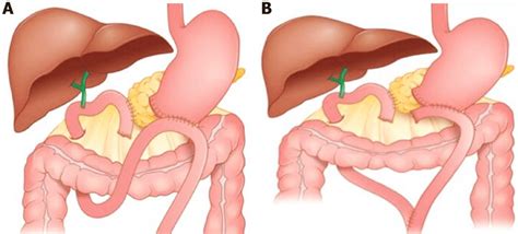 Traditional single loop reconstruction (A), and the Roux en Y with an... | Download Scientific ...