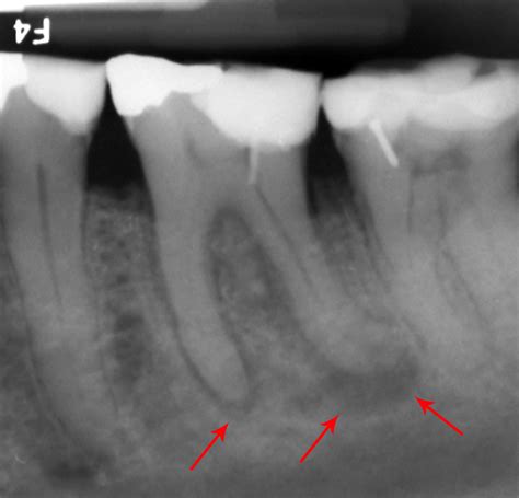 What Causes a Tooth to Abscess? - Dental Health Society