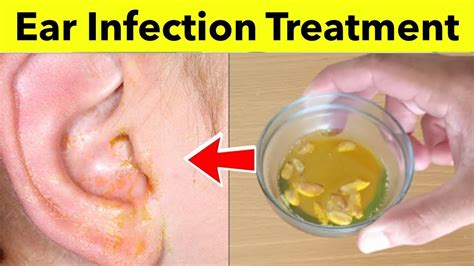 Brilliant Tips About How To Cure A Baby Ear Infection - Blockbath71