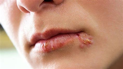 Herpes Lips