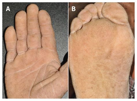 Tripe Palm And Acanthosis Nigricans- Diagnosis? - MEDizzy Journal