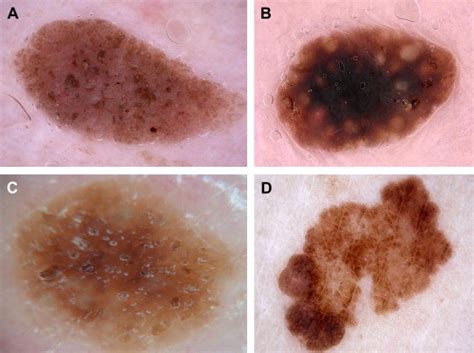 Dermatoscopy for Melanoma and Pigmented Lesions - Dermatologic Clinics