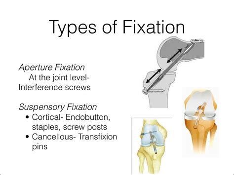 Acl graft fixation options