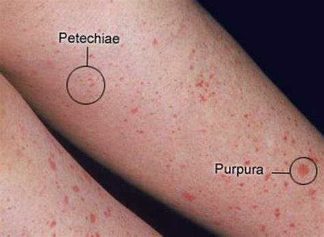 Diferencia entre la púrpura de petequias y la equimosis | Differbetween