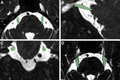 Nerve atrophy in trigeminal neuralgia due to neurovascular compression and its association with ...