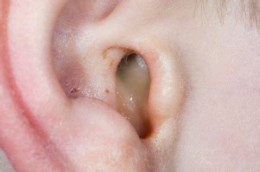 NHS 111 Wales - Health A-Z : Ear infection