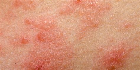 Is Eczema Contagious? Here's the Absolute Truth | SELF