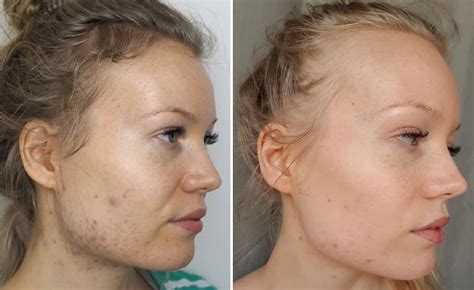 Skin update - 6 months of birth control pills for acne