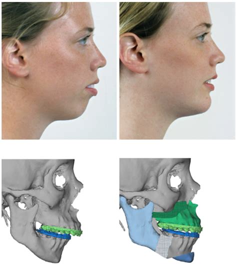 What is Jaw Surgery & How Jaw surgery is performed? | by Maxillofacialsurgeryindia | Medium