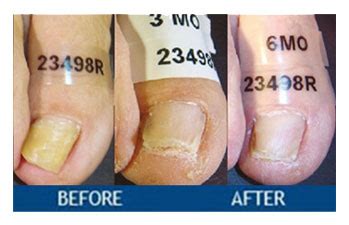 Laser Toenail Fungus Treatment Before And After - Nail Ftempo