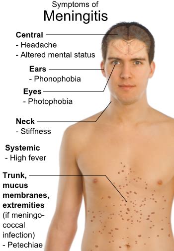 Meningococcal meningitis symptoms