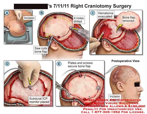 AMICUS Illustration of amicus,surgery,craniotomy,skull,bone,incision ...