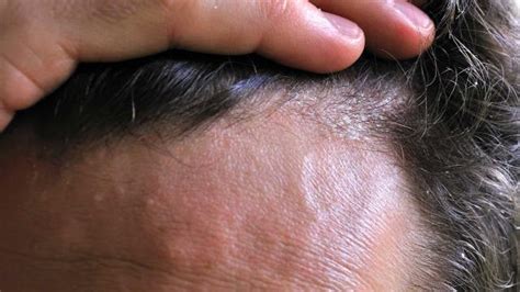 Management of Scalp Psoriasis | 1mhealthtips.com