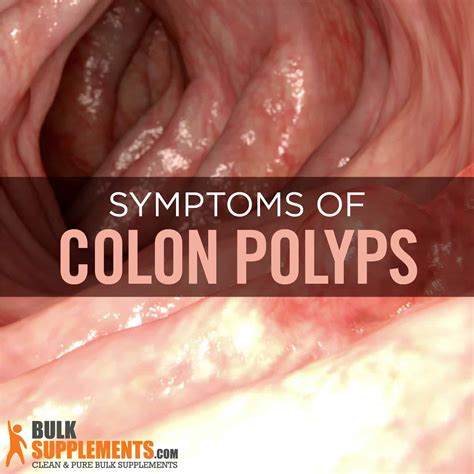 Colon Polyps. Learn How to Prevent Them Now with Supplements!