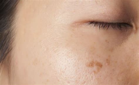 7 Natural Remedies For Dark Spots | Prevention