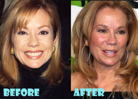 Kathie Lee Gifford Plastic Surgery Before and After - Lovely Surgery