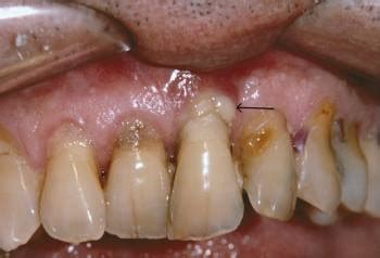 Periodontitis - Trastornos bucales y dentales - Manual MSD versión para público general