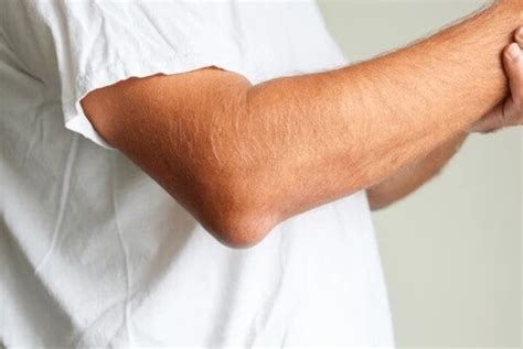 Lump On Elbow: Causes & Treatment For Elbow Bumps & Lumps