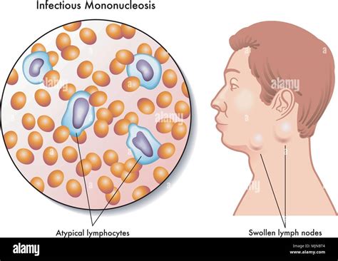 Infectious Mononucleosis Symptoms - Goimages 411