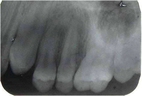 Necrosis of the revascularized pulp in an immature infected maxillary second premolar following ...