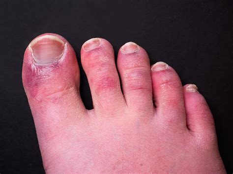 ‘Covid Toes’ Are Caused By Coronavirus Infecting The Lining Of Blood Vessels, Says New Study