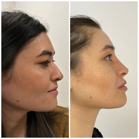 Nose Treatment Without Surgery: A Non-Invasive Approach To Enhancing ...