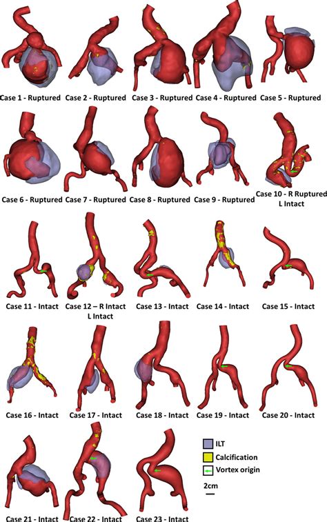 Morphology and Hemodynamics in Isolated Common Iliac Artery Aneurysms Impacts Proximal Aortic ...