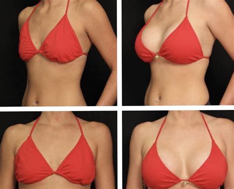 Before And After Plastic Surgery Breast Augmentation