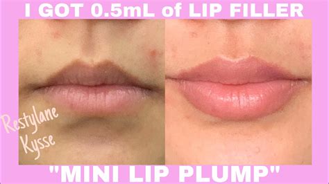 Restylane Lips Before And After | Lipstutorial.org