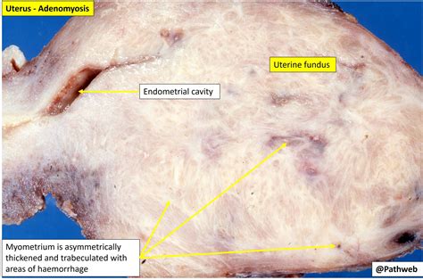 Adenomyosis - RobanaChinelo