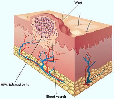 How To Get Rid Of Gentile Warts - Religionisland Doralutz