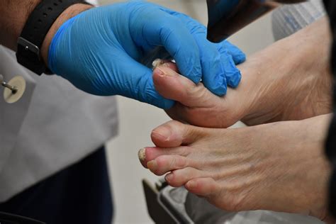 How to Break Up Scar Tissue After Bunion Surgery — FOOT & ANKLE CENTERS