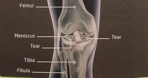 KNEE LIGAMENT INJURY | Klinique Pain Management & Wellbeing Clinic