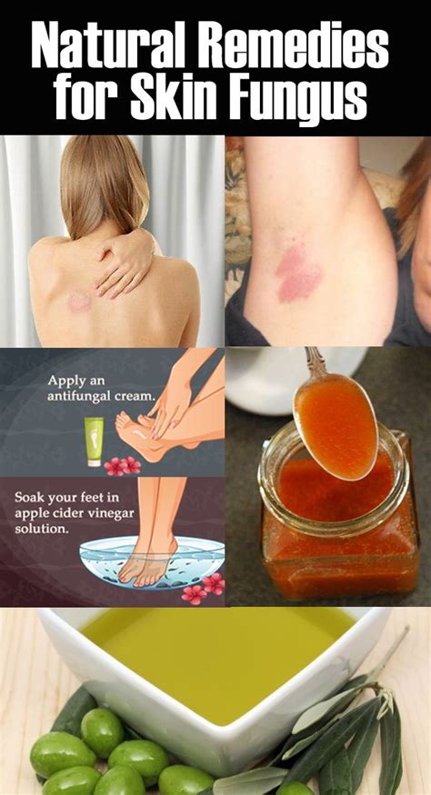 Speedy Home Remedies for Skin Fungus | Home remedies for skin, Remedies ...