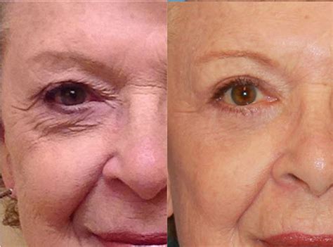 Eyelid Surgery - Upper & Lower, Blepharoplasty Surgery, Recovery