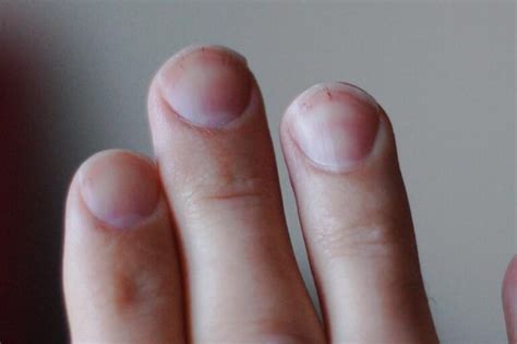 What Your Fingernails Can Reveal About the Risk of Lung Cancer ...