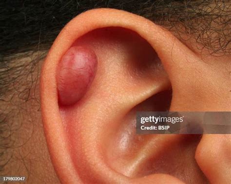 122 Keloid Scar Stock Photos, High-Res Pictures, and Images - Getty Images