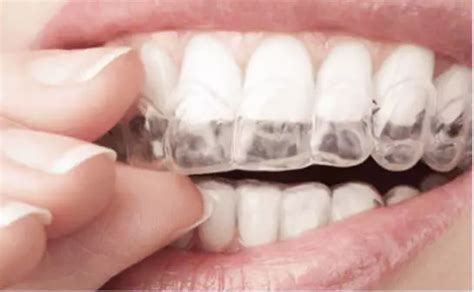 Invisible Braces Cost in Chennai | Invisalign Treatment in Chennai